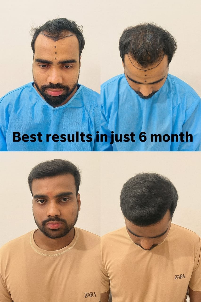 Before Hair Transplant