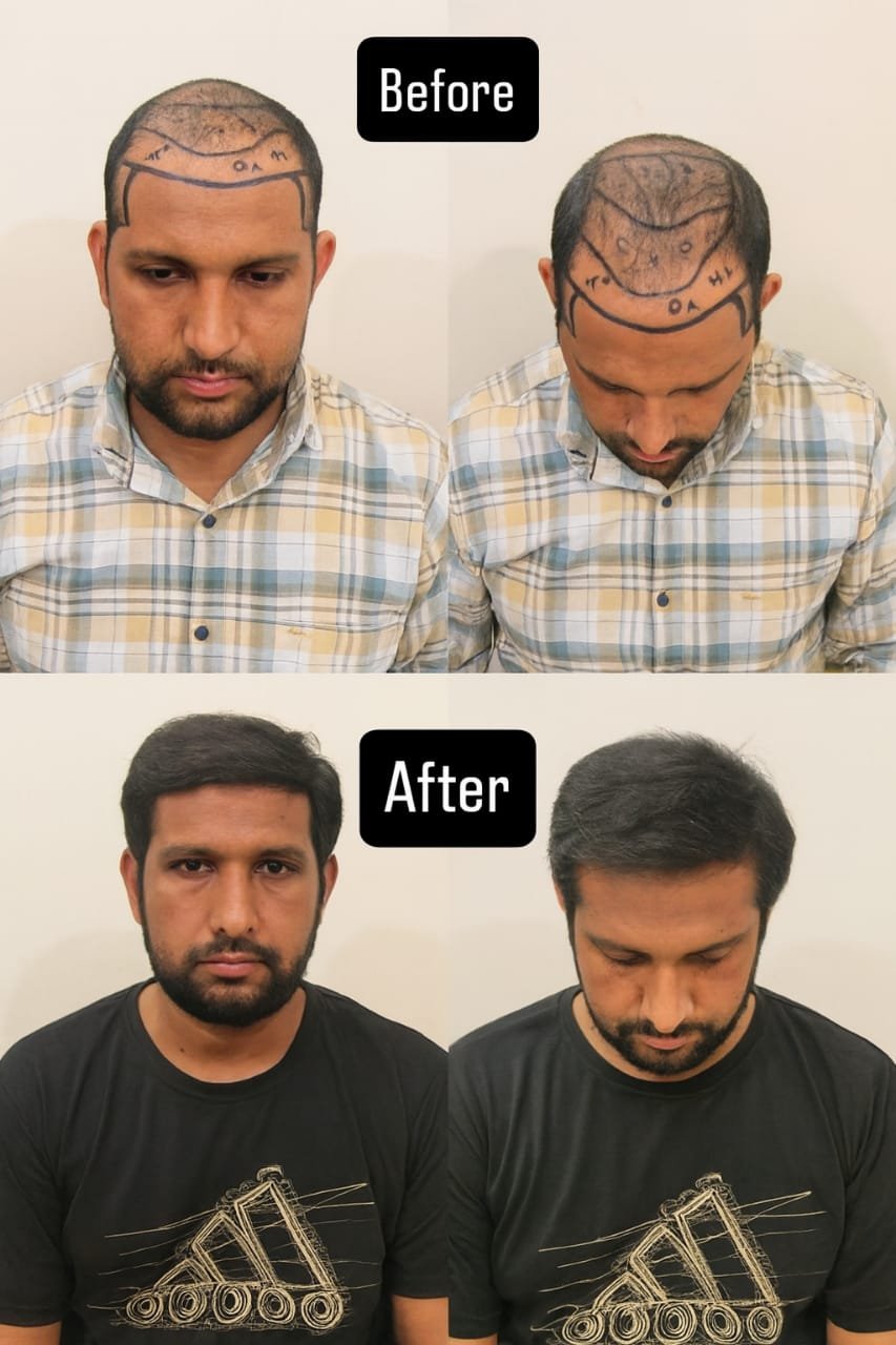 After Hair Transplant