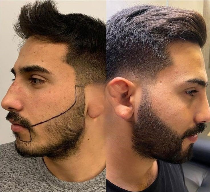 Beard Transplant